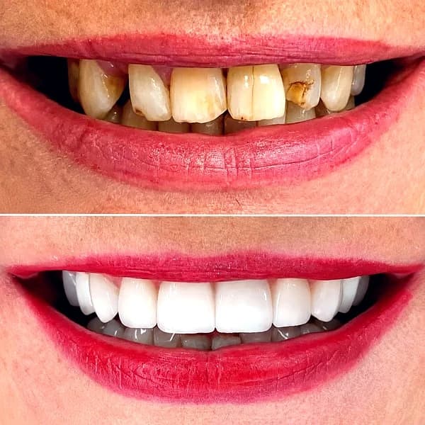 Smile Design (Veneers) - photo 2