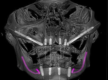 Zygomatic Implants Cost - Palmerston North vs Stunning Dentistry