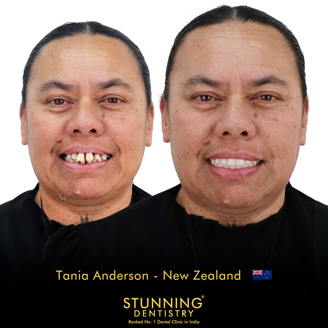 Full Smile Transformation - photo 3