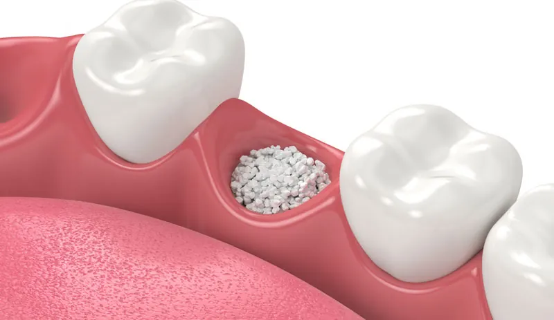 Bone Grafting & Advanced Surgical Support