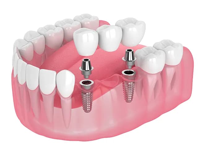 Multiple Implant Rehabilitation