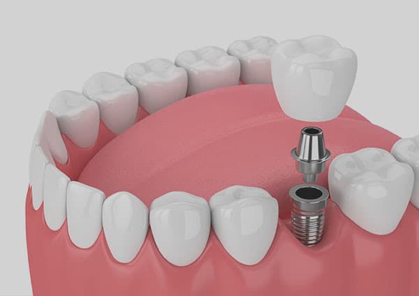 Single Tooth Implant