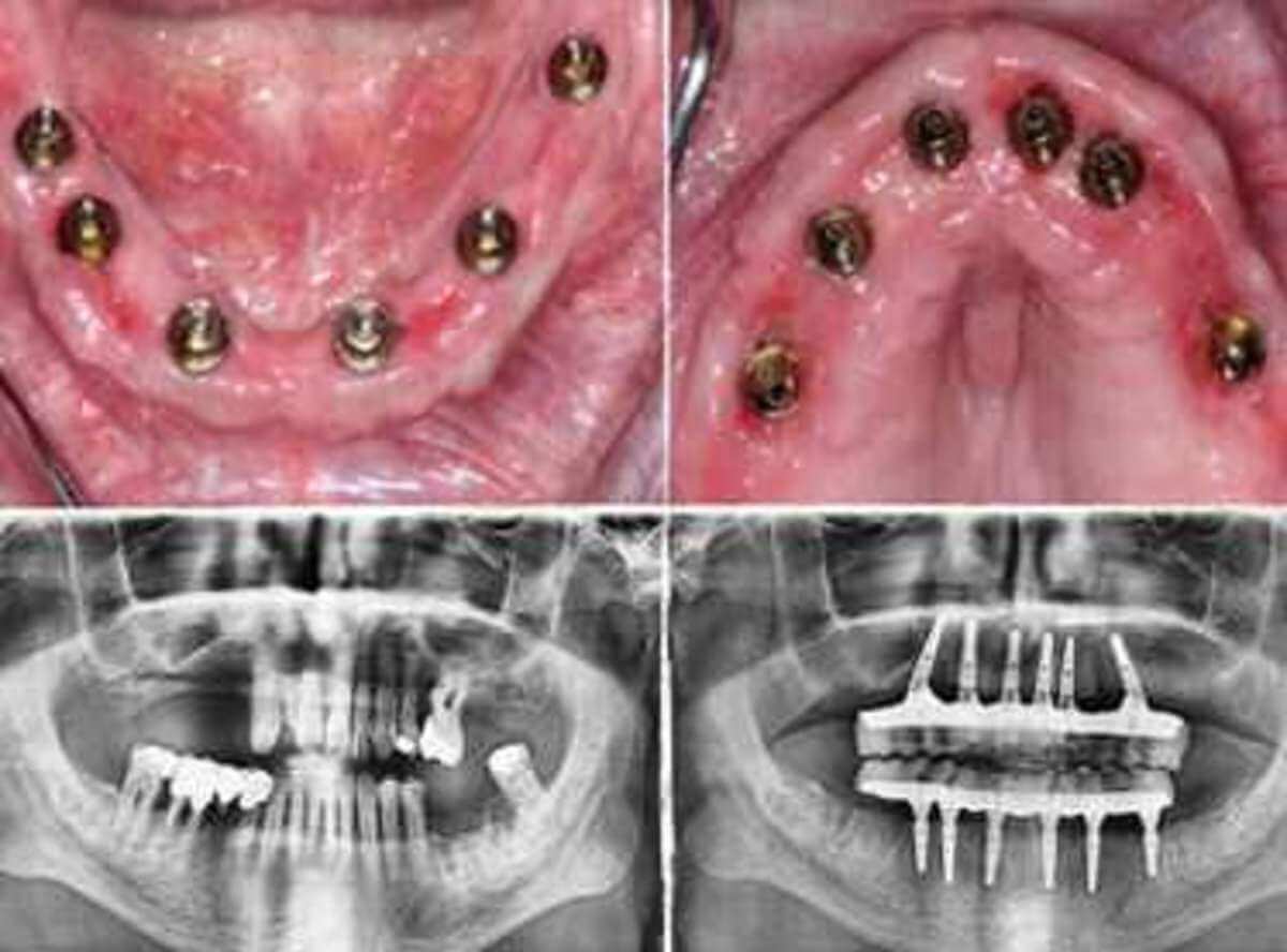 Dental Implants Cost Guide