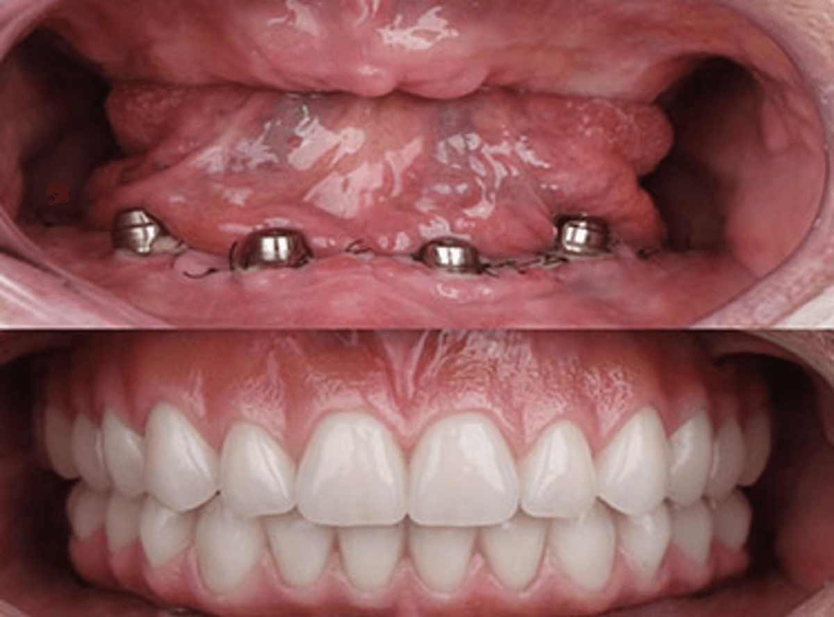 Types of Implant-Supported Dentures