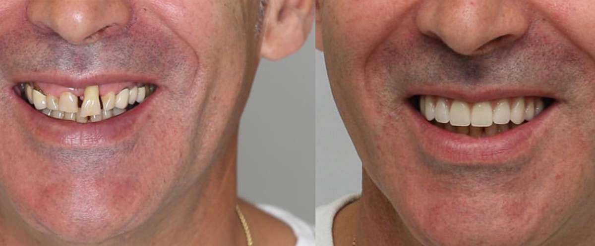 What Full Mouth Rehabilitation Actually Is