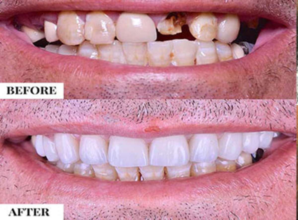 What Teeth in a Day Actually Means