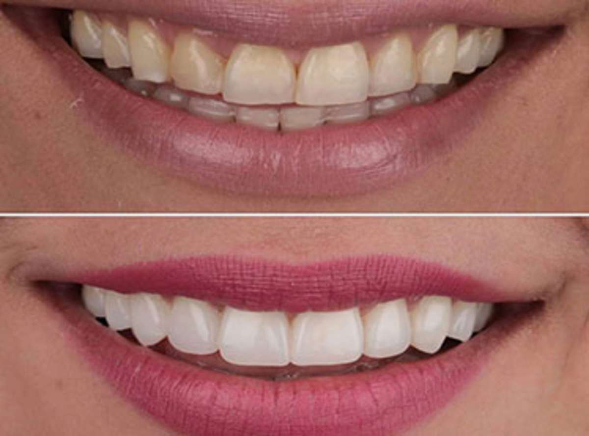 Porcelain Veneers, Clinical Reality {#porcelain-veneers}