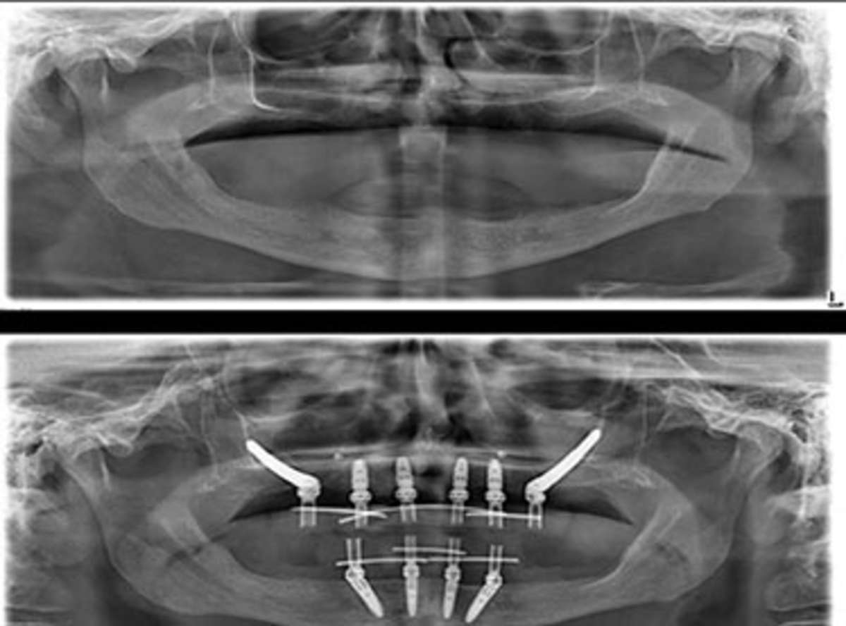 Surgical Lead, Zygomatic Implants