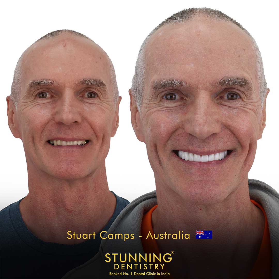 Dental implant before and after case 6