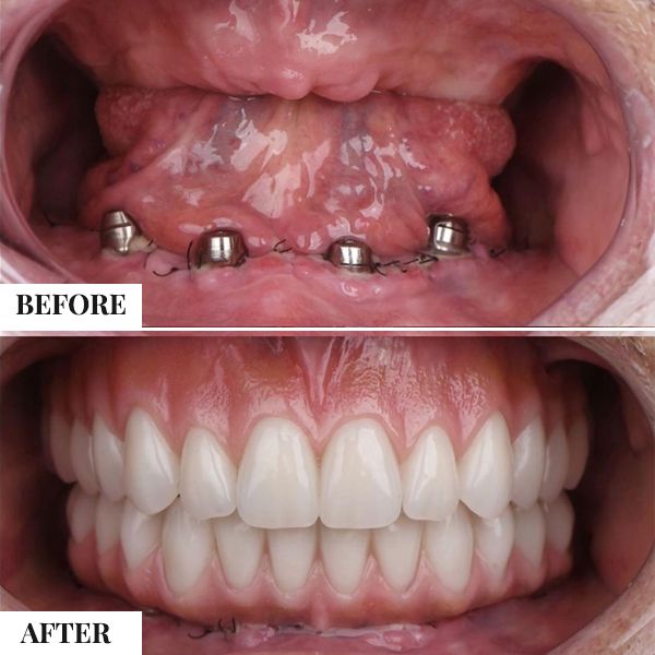 Full Mouth Rehabilitation - photo 2