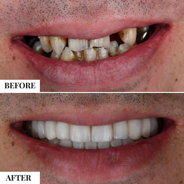 Full Mouth Rehabilitation - photo 2