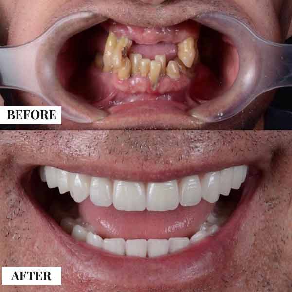 Smile Design (Veneers) - photo 2