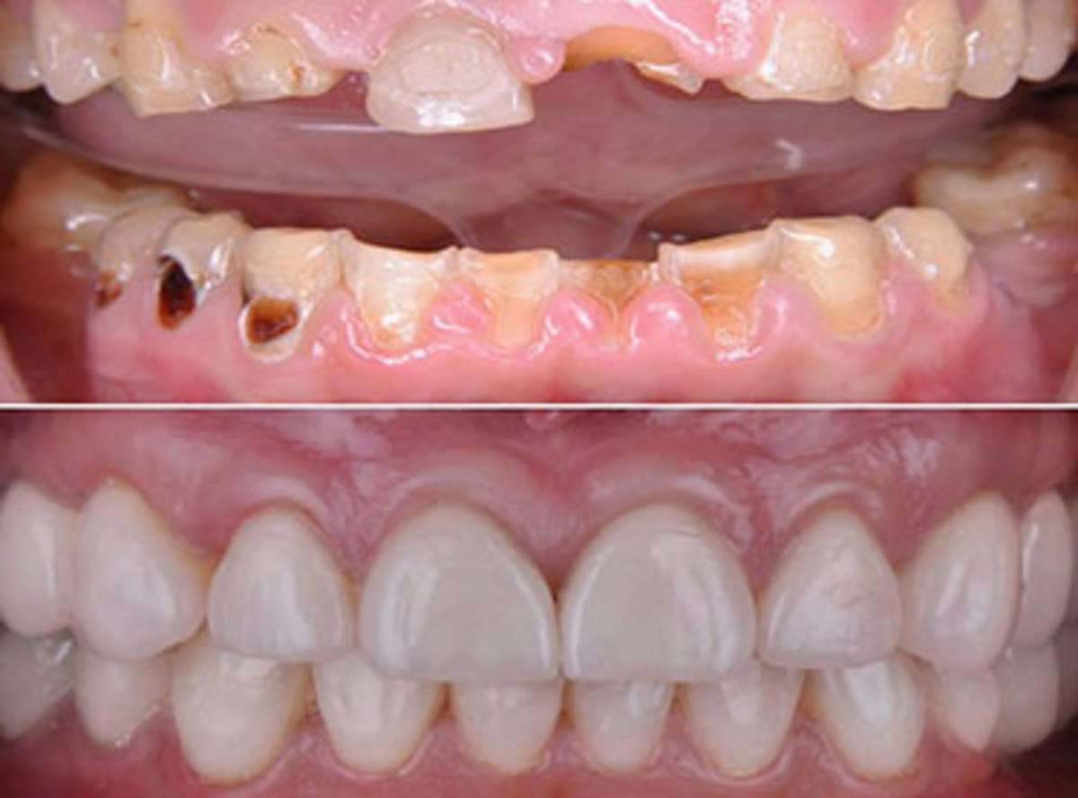 Implant Brands and Material Quality
