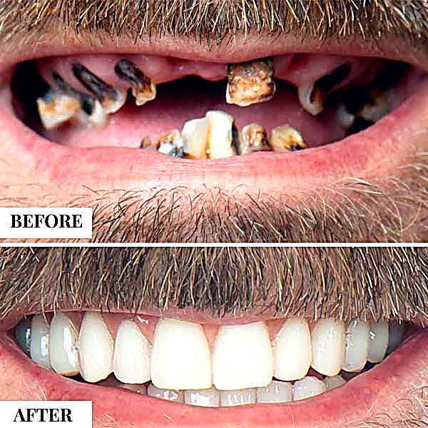 All-on-4 dental implants treatment case at Stunning Dentistry