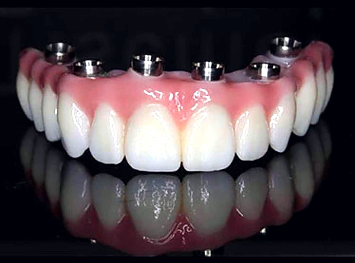 All-on-6 implant-supported full arch