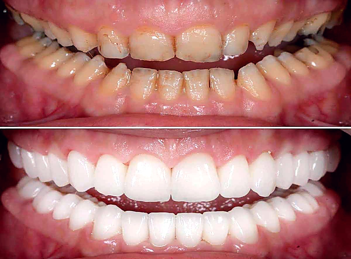 Full mouth rehabilitation patient at Stunning Dentistry New Delhi