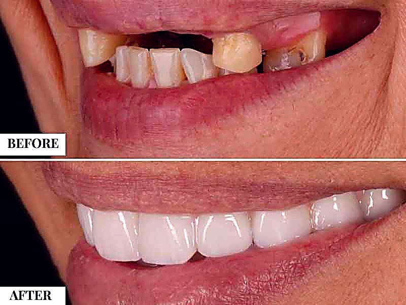 Smile design makeover before and after